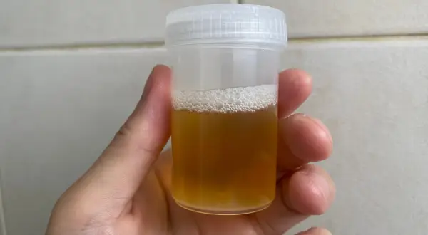 Pojemnik z żółtym moczem, gotowy do badania. Ile ml moczu do badania? Około 50 ml.