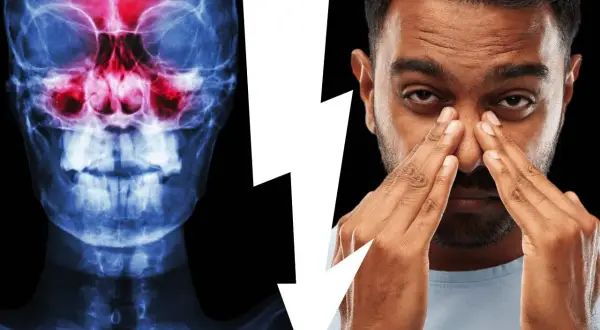 Radiografia dei seni paranasali con infiammazione e uomo che si tocca il naso, suggerendo un problema di sinusite odontogena e la necessità di un intervento.