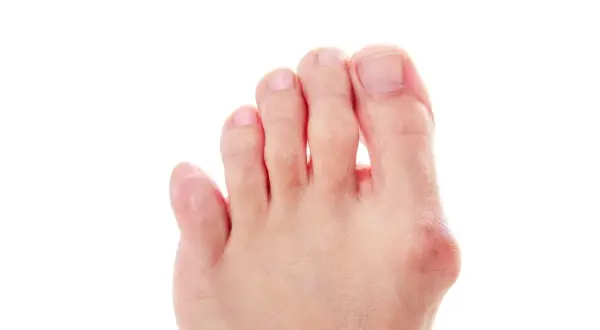 Piede con alluce valgo e dita leggermente piegate, suggerimenti su come raddrizzare le dita dei piedi.