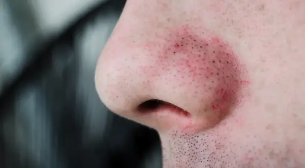 Gros plan sur un nez humain avec des pores dilatés et des points noirs visibles, la peau est légèrement irritée et rouge.