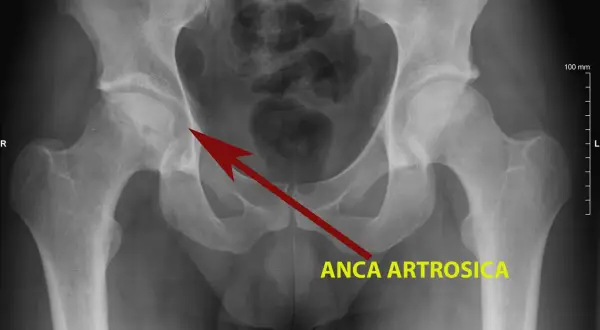 Radiografia del bacino che mostra un'anca artrosica, con il tipico "scrocchio" dovuto all'usura della cartilagine.