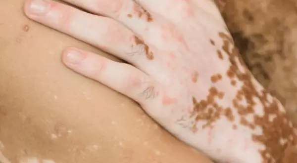 Nära bild på en hand med fläckar av lentigo solaris och vitiligo. Huden har varierande pigmentering.
