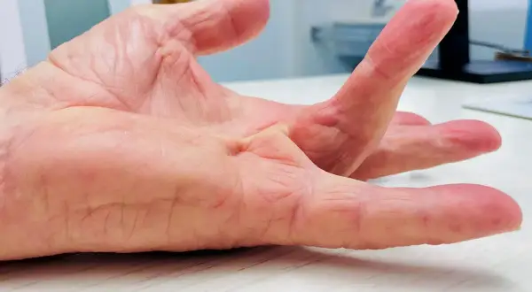 Przykurcz Dupuytrena: Do jakiego lekarza? Pełny przewodnik i diagnoza