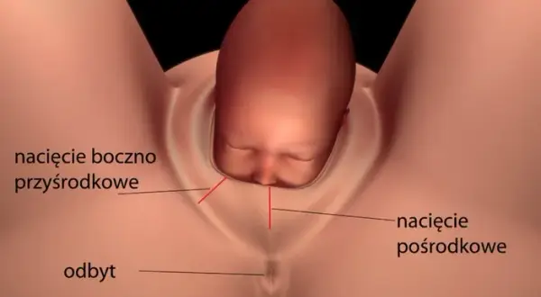 Jak długo boli nacięcie krocza po porodzie? Czas gojenia i ból.