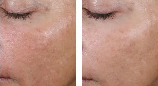 Comparaison avant/après : peau avec rougeurs et irrégularités, puis peau plus lisse et uniforme, peut-être grâce au retinol ou acide hyaluronique.