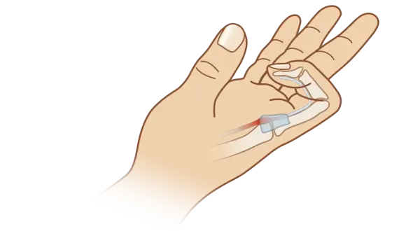 Illustration einer Hand, die zeigt, wie die Finger schmerzen beim Beugen durch eine Entzündung im Sehnenbereich.
