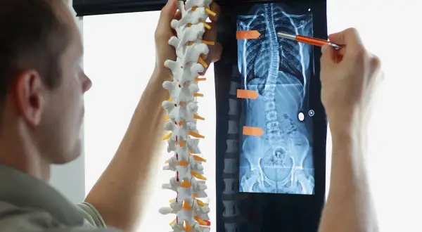 Un médecin examine une radiographie montrant une scoliose. La courbure vertébrale peut affecter l'espérance de vie.