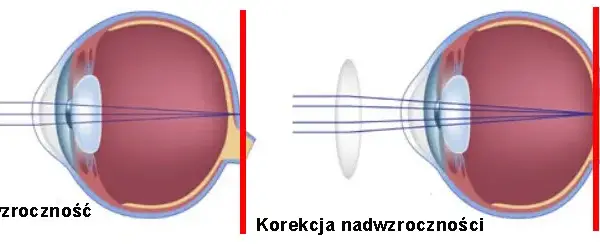 Wada wzroku jak widzi: jak różne wady wpływają na percepcję świata