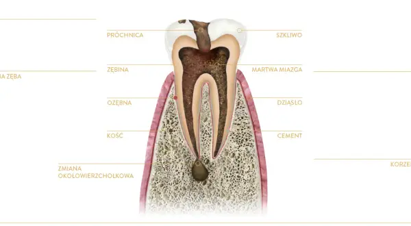 Przekrój zęba z widoczną próchnicą, martwą miazgą i zmianą okołowierzchołkową. To ilustracja wyjaśniająca, endodoncja co to jest.
