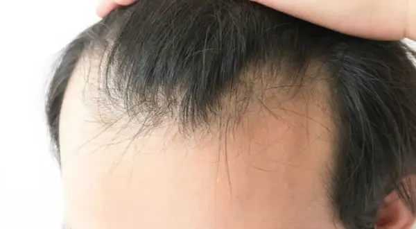 Primer plano de la línea del cabello de un hombre, mostrando adelgazamiento y entradas. Una mano toca la parte superior de la cabeza, quizás preguntándose porque los hombres se quedan calvos.