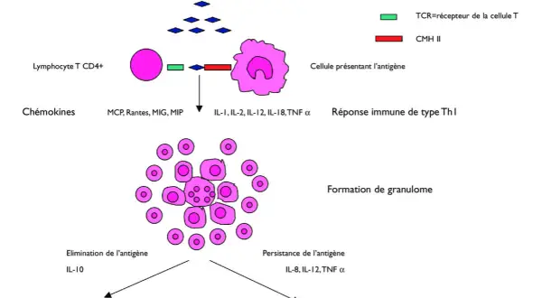 Schéma illustrant la formation de granulomes, un symptôme de la sarcoïdose, impliquant des lymphocytes T et des cellules présentant l'antigène.