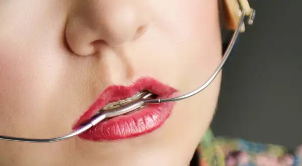 Labbra rosse con apparecchio ortodontico, un dettaglio del viso con un apparecchio baffo che si estende verso l'orecchio.