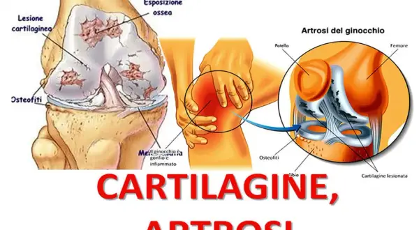 Illustrazione anatomica del ginocchio con artrosi, che mostra lesioni cartilaginee, esposizione ossea e osteofiti. Il ginocchio si piega al ginocchio.