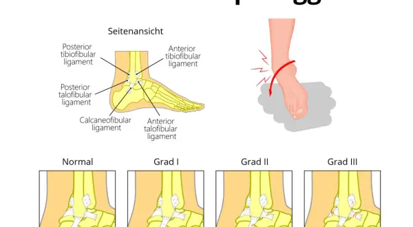 Illustration zeigt einen Bänderriss am Sprunggelenk, mit Fokus auf das ligamentum fibulotalare anterius und verschiedene Schweregrade.