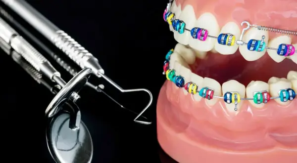Kolorowy aparat ortodontyczny na modelach szczęk, symbolizujący korektę zgryzu krzyżowego przed i po. Obok narzędzia dentystyczne.