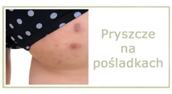 Co na pryszcze na pupie? Domowe SPA i pomoc dermatologa.
