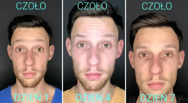 Trzy zdjęcia mężczyzny pokazujące efekt botoksu na czole: dzień 1 (zmarszczki), dzień 4 i 7 (gładka skóra).