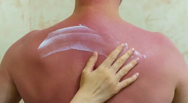 Eine Hand trägt Salbe auf einen stark sonnenverbrannten, roten Rücken auf.