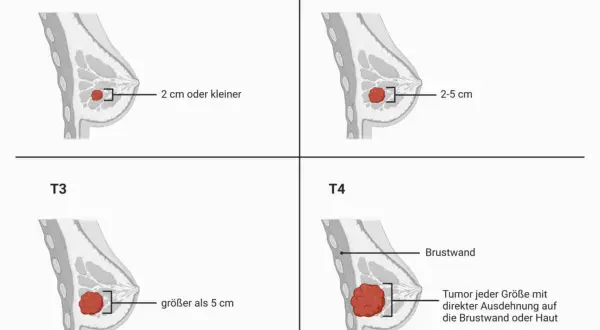 Veranschaulicht die **Mammakarzinom Stadien** T1 (kleiner als 2 cm), T2 (2-5 cm), T3 (größer als 5 cm) und T4 (Ausdehnung auf Brustwand/Haut).
