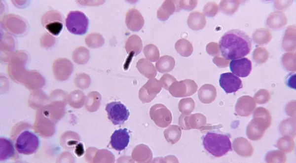 Blutausstrich mit Lymphozyten und Erythrozyten. Die Anzahl der Lymphozyten kann Hinweise auf die cll lebenserwartung geben.