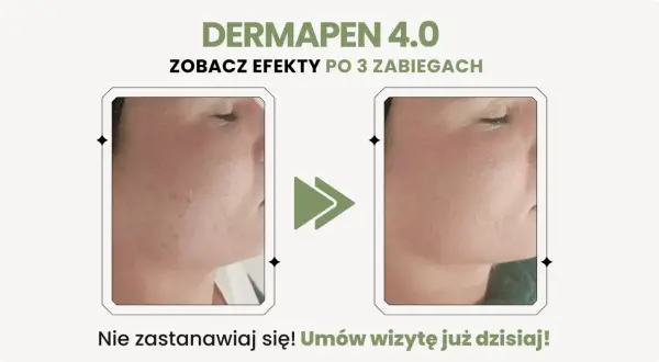 Przed i po zabiegu Dermapen 4.0: widoczne dermapen efekty po 3 zabiegach, skóra gładsza i bez niedoskonałości.