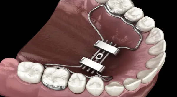 Dettaglio di un espansore palatale metallico applicato ai denti superiori per correggere la mascella.
