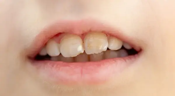 Jak wyleczyć próchnicę bez dentysty? Co możesz, a czego nie!