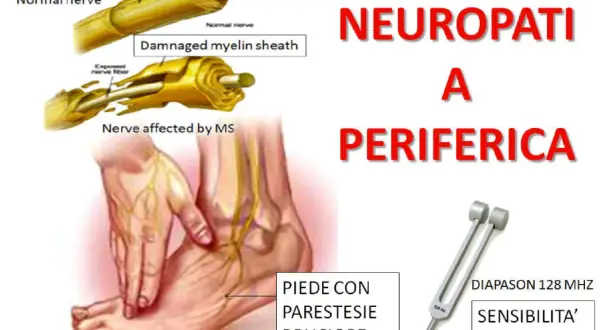 Immagine illustra cosa vuol dire neuropatia periferica: nervi sani e danneggiati, un piede con parestesie e bruciore, e un diapason per testare la sensibilità vibratoria.