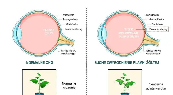 Porównanie normalnego oka z suchym zwyrodnieniem plamki żółtej. Obraz ukazuje, jak odbudowa plamki żółtej jest kluczowa dla normalnego widzenia.