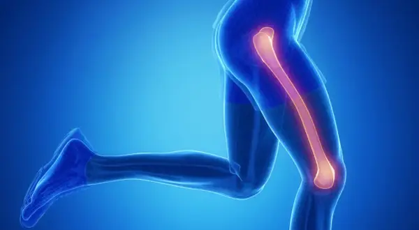 Anatomia nogi z podświetloną kością udową, sugerującą złamanie kości udowej.