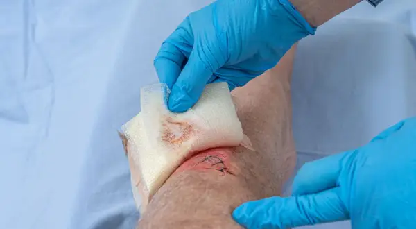 Blaue Handschuhe bedecken eine genähte, offene Wunde am Knie, die mit Gaze abgetupft wird.