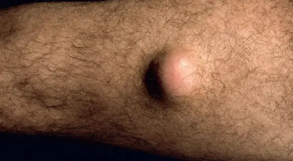 Ein gutartiger Tumor, eine helle, runde Beule, hebt sich auf der behaarten Haut eines Arms ab.
