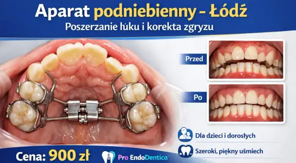 Aparat podniebienny poszerza łuk zębowy, korygując zgryz. Zdjęcia "przed" i "po" pokazują efekty leczenia.