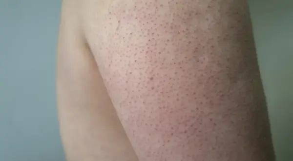 Närbild på arm med keratosis pilaris. Små röda prickar syns över hela huden, vilket kan vara ett tecken på att behandling behövs.
