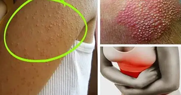 Nietolerancja glutenu i laktozy: objawy, diagnostyka i jak odróżnić