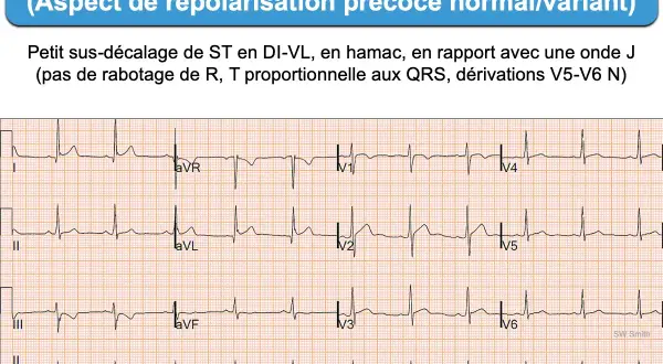 Électrocardiogramme montrant une dérivation VL avec un léger sus-décalage de ST, aspect de repolarisation précoce. L'ECG D2 long révèle une onde J.
