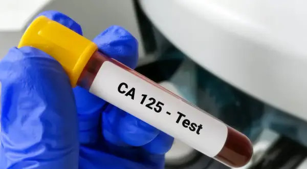 Rękawiczka w niebieskiej rękawiczce trzyma probówkę z krwią z etykietą "CA 125 - Test". To badanie pomaga wykryć pewne schorzenia.