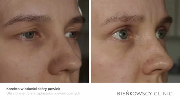 Opadająca powieka przed i po zabiegu. Poprawa jędrności skóry wokół oczu, widoczna na zdjęciach porównawczych.