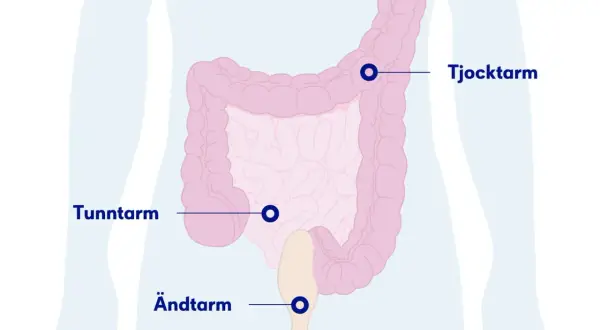 Illustration av tunntarm, tjocktarm och ändtarm. Om du upplever symtom på inflammation i tunntarmen, sök vård.