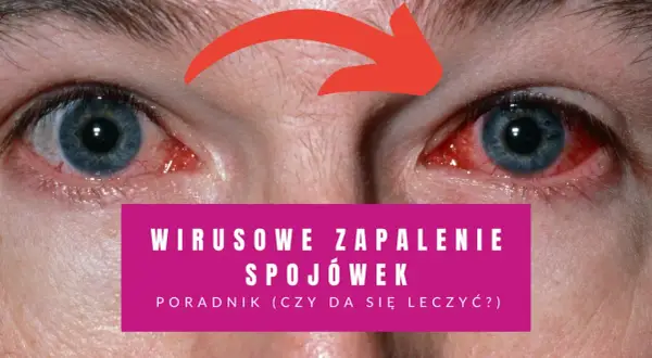 Czerwone, podrażnione oczy z widocznymi naczynkami. Napis informuje o wirusowym zapaleniu spojówek i poradniku leczenia.