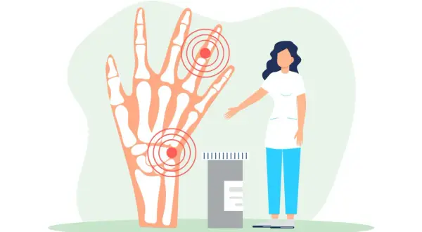 Illustrazione di una mano con ossa evidenziate e cerchi rossi che indicano dolore alle dita delle mani quando stringo. Vicino, una dottoressa e un flacone di pillole.