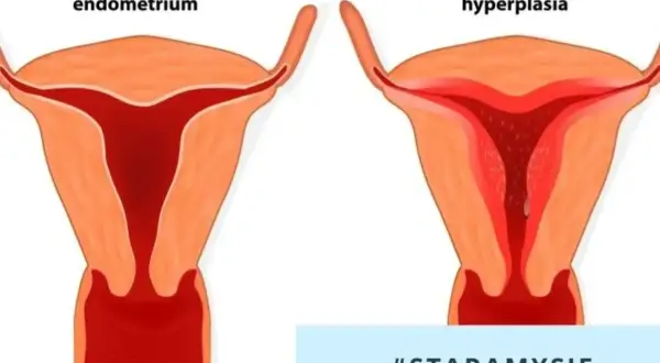 Porównanie prawidłowego endometrium z przerostem. Przerost endometrium może wymagać leczenia.