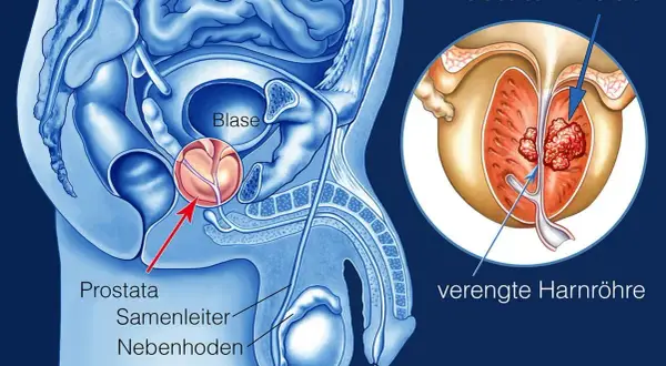 Anatomie der männlichen Beckenorgane mit Fokus auf Prostatakrebs. Ein vergrößerter Ausschnitt zeigt Tumore in der Prostata, die die Harnröhre verengen. Mögliche Prostatakrebs-Metastasen sind angedeutet.