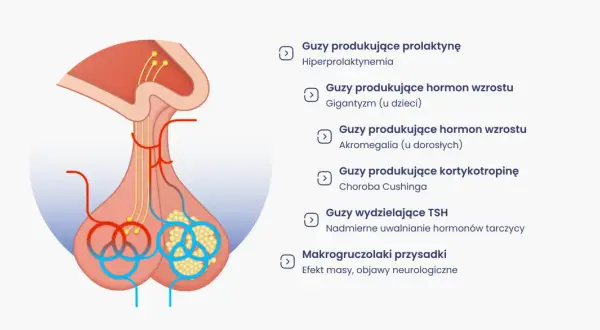 Ilustracja przedstawia przysadkę mózgową i różne guzy, które mogą wpływać na jej funkcjonowanie, powodując objawy takie jak gigantyzm czy akromegalia.