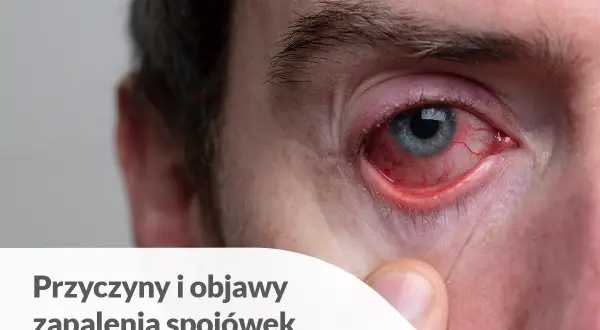 Silnie zaczerwienione oko z widocznymi naczynkami. To objaw zapalenia spojówek, które może być spowodowane różnymi czynnikami, w tym infekcjami lub alergią.