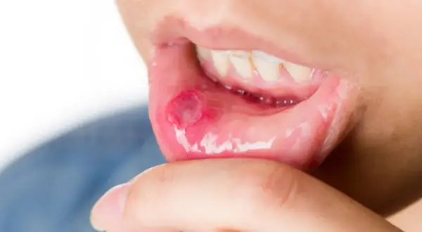 Afta a dentysta: Kiedy iść, a kiedy przełożyć wizytę?
