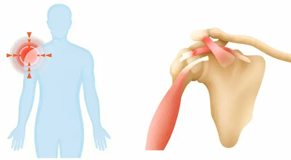 Ból barku, zwany też SST (ang. Shoulder pain), to częsty problem. Obraz pokazuje ból w barku i budowę stawu.