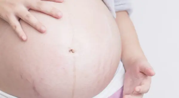 Barriga de embarazada con estrías moradas, un signo de la vida que crece.
