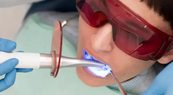 Stomatolog utwardza plombę światłem UV. Czy wymiana plomby boli? Zazwyczaj nie, jeśli zabieg jest wykonany profesjonalnie.