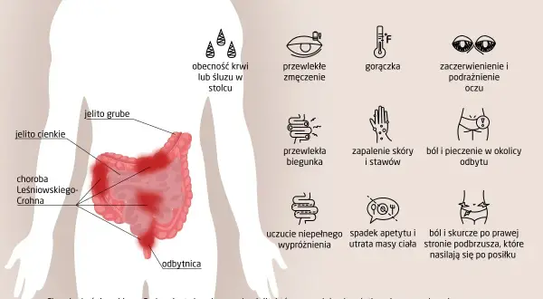 Ilustracja przedstawia objawy choroby Leśniowskiego-Crohna: zmęczenie, gorączkę, biegunkę, bóle brzucha, problemy z oczami i skórą.